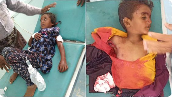 مقتل طفل وإصابة شقيقته في اعتداءات حوثية بجنوب الحديدة