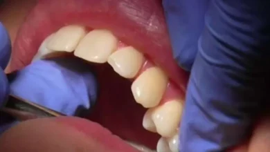 دراسة: تساقط الأسنان السريع مؤشر مبكر على مخاطر صحية قاتلة 7 دراسة: تساقط الأسنان السريع مؤشر مبكر على مخاطر صحية قاتلة