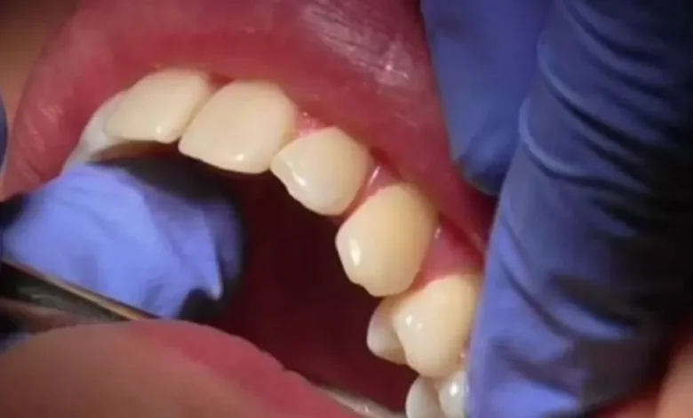 دراسة: تساقط الأسنان السريع مؤشر مبكر على مخاطر صحية قاتلة 1 دراسة: تساقط الأسنان السريع مؤشر مبكر على مخاطر صحية قاتلة