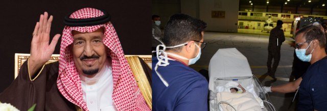 الملك السعودي يوجه بإجراء عملية فصل التوأم الطفيلي اليمني