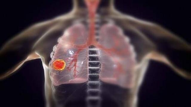 علامات في صوتك تدل على الإصابة بسرطان الرئة 1 علامات في صوتك تدل على الإصابة بسرطان الرئة