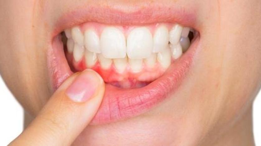 ماذا تعرف عن التهابات اللثة؟