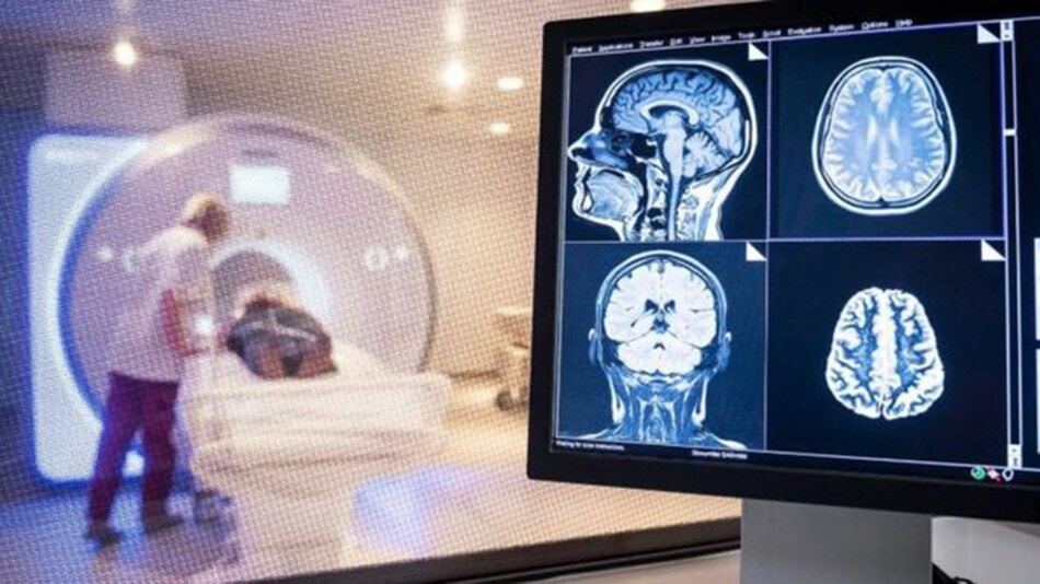 كورونا وأمراض الدماغ.. دراسة تكشف الصلة الوثيقة 
