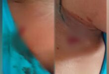 إصابة طفلة برصاص قناص حوثي في تعز