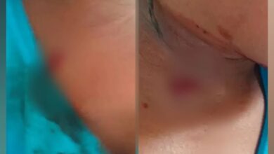 إصابة طفلة برصاص قناص حوثي في تعز