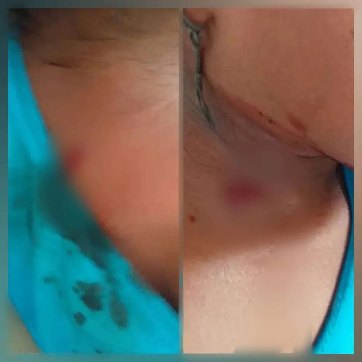 إصابة طفلة برصاص قناص حوثي في تعز