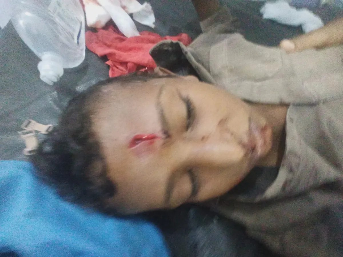 إصابة طفل بانفجار مقذوف من مخلفات مليشيا الحوثي في حيس