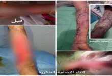 مستشفى حيس ينجح في إنقاذ مريضة من عدوى بكتيرية فتاكة بعد عمليات جراحية معقدة