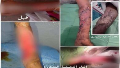 مستشفى حيس ينجح في إنقاذ مريضة من عدوى بكتيرية فتاكة بعد عمليات جراحية معقدة