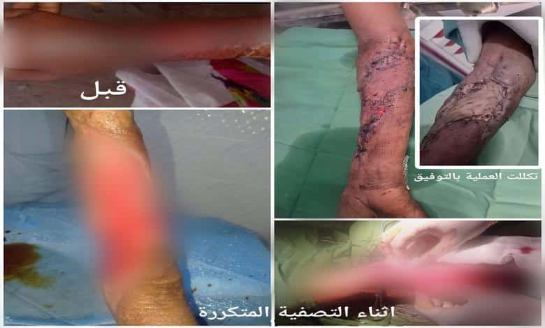مستشفى حيس ينجح في إنقاذ مريضة من عدوى بكتيرية فتاكة بعد عمليات جراحية معقدة
