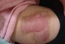 تعز.. مطالبات بتحقيق عاجل في واقعة تعذيب أطفال على يد زوجة أبيهم بالمواسط