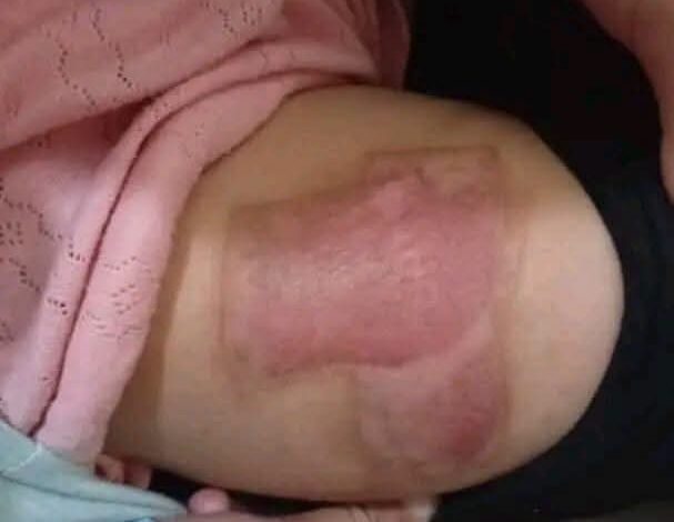 تعز.. مطالبات بتحقيق عاجل في واقعة تعذيب أطفال على يد زوجة أبيهم بالمواسط 1 تعز.. مطالبات بتحقيق عاجل في واقعة تعذيب أطفال على يد زوجة أبيهم بالمواسط