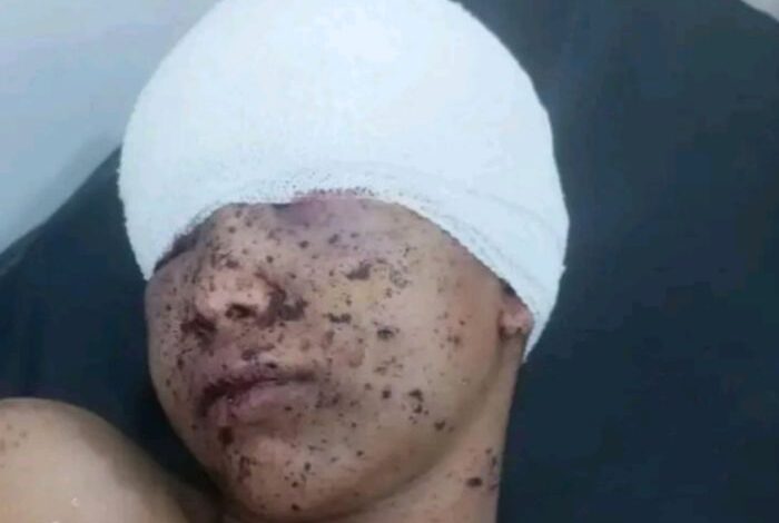 تعز.. قذيفة حوثية تصيب طفلاً وتحرمه من إحدى عينيه 1 تعز.. قذيفة حوثية تصيب طفلاً وتحرمه من إحدى عينيه