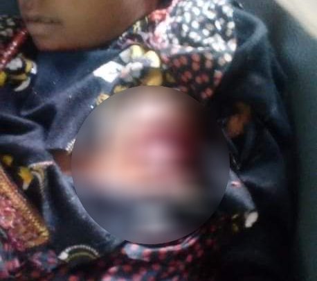 بعد شهرين من قتل شقيقتها.. استشهاد طفلة برصاصة قناص حوثي بحيس
