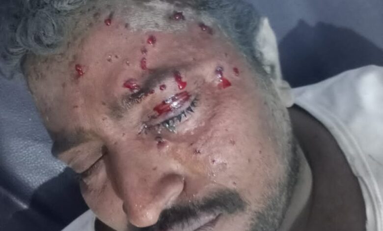 الحديدة.. إصابة مزارع بجروح بالغة جراء انفجار لغم من مخلفات الحوثي في حيس 1 الحديدة.. إصابة مزارع بجروح بالغة جراء انفجار لغم من مخلفات الحوثي في حيس