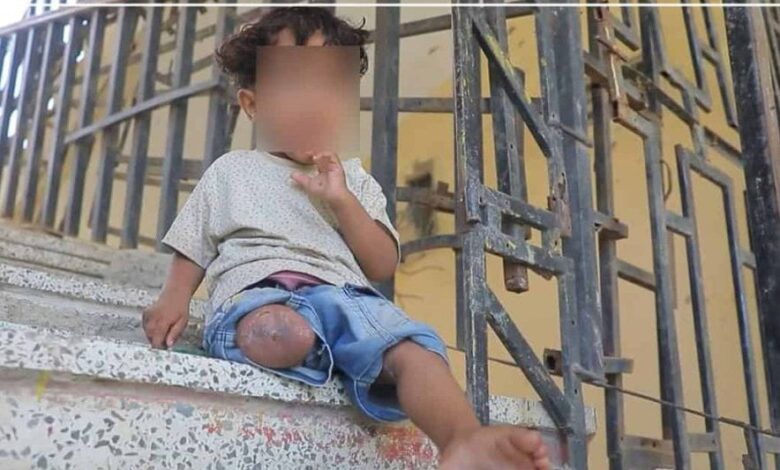 اعتراف حوثي يكشف كلفة الحرب: 15% من اليمنيين في دائرة الإعاقة بسبب الألغام والمعارك