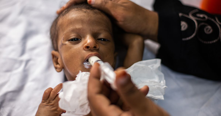 اليونيسف: أكثر من مليوني طفل مصاب بسوء التغذية الحاد في اليمن بحاجة للرعاية العلاجية