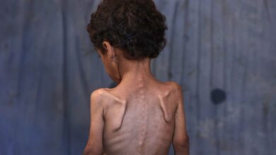 اليونيسف: أكثر من مئة طفل يومياً في غزة يواجهون سوء التغذية