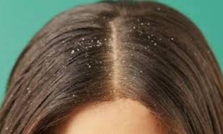 ما أسباب ظهور قشرة الرأس؟ 1 ما أسباب ظهور قشرة الرأس؟