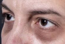 الهالات السوداء حول العين.. كيف تنشأ؟ وما علاجها؟