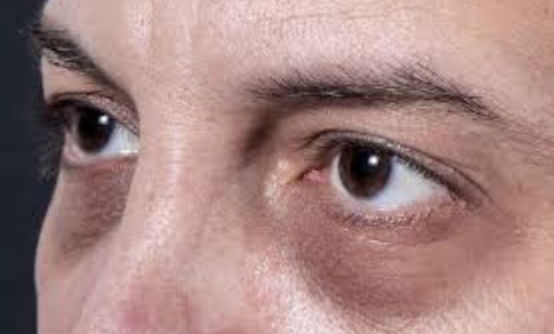 الهالات السوداء حول العين.. كيف تنشأ؟ وما علاجها؟