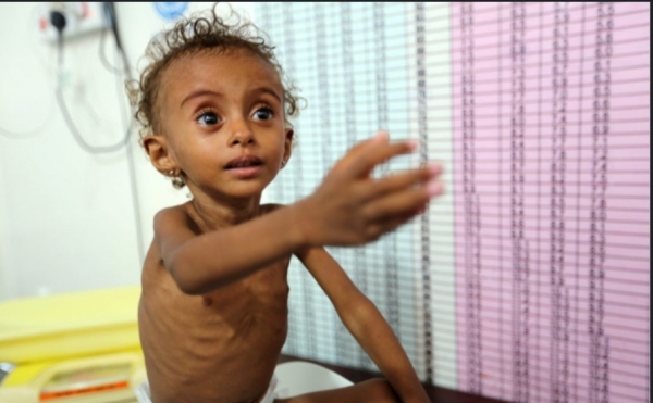 تقرير دولي يحذر من ارتفاع حالات سوء التغذية بين الأطفال في اليمن إلى مستوى "مقلق وخطير"