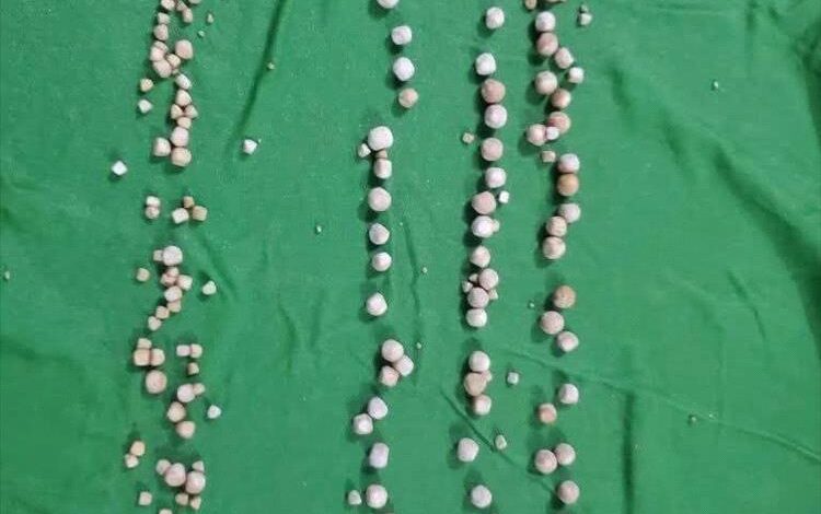 إنجاز طبي نوعي في شبوة.. استخراج 193 حصوة من مريض دون جراحة مفتوحة
