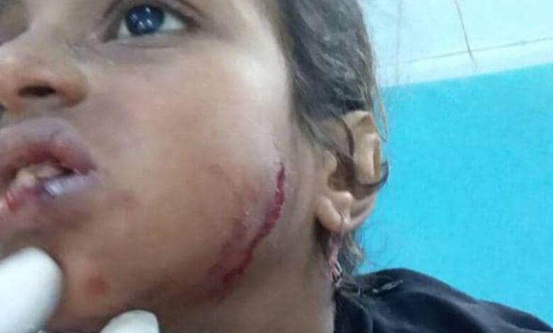 جرح طفلة في اعتداء حوثي مسلح جنوب الحديدة