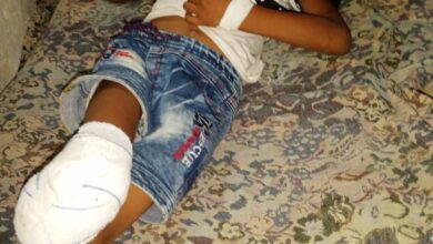 إجراء عملية بتر لطفل أصيب بقذيفة حوثية قبل سنوات في الخوخة